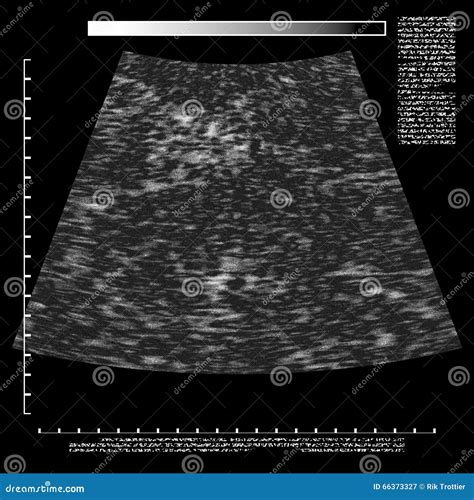 Blank Ultrasound Template